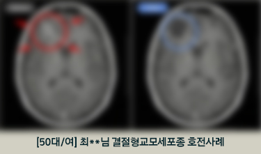 [50대/여] 최**님 결절형교모세포종 호전사례