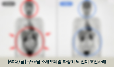 [60대/남] 구**님 소세포폐암 확장기 뇌 전이 호전사례