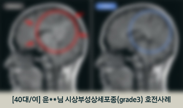 [40대/여] 윤**님 시상부성상세포종(grade3) 호전사례