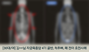 [30대/여] 김**님 자궁육종암 4기 골반, 척추뼈, 폐 전이 호전사례